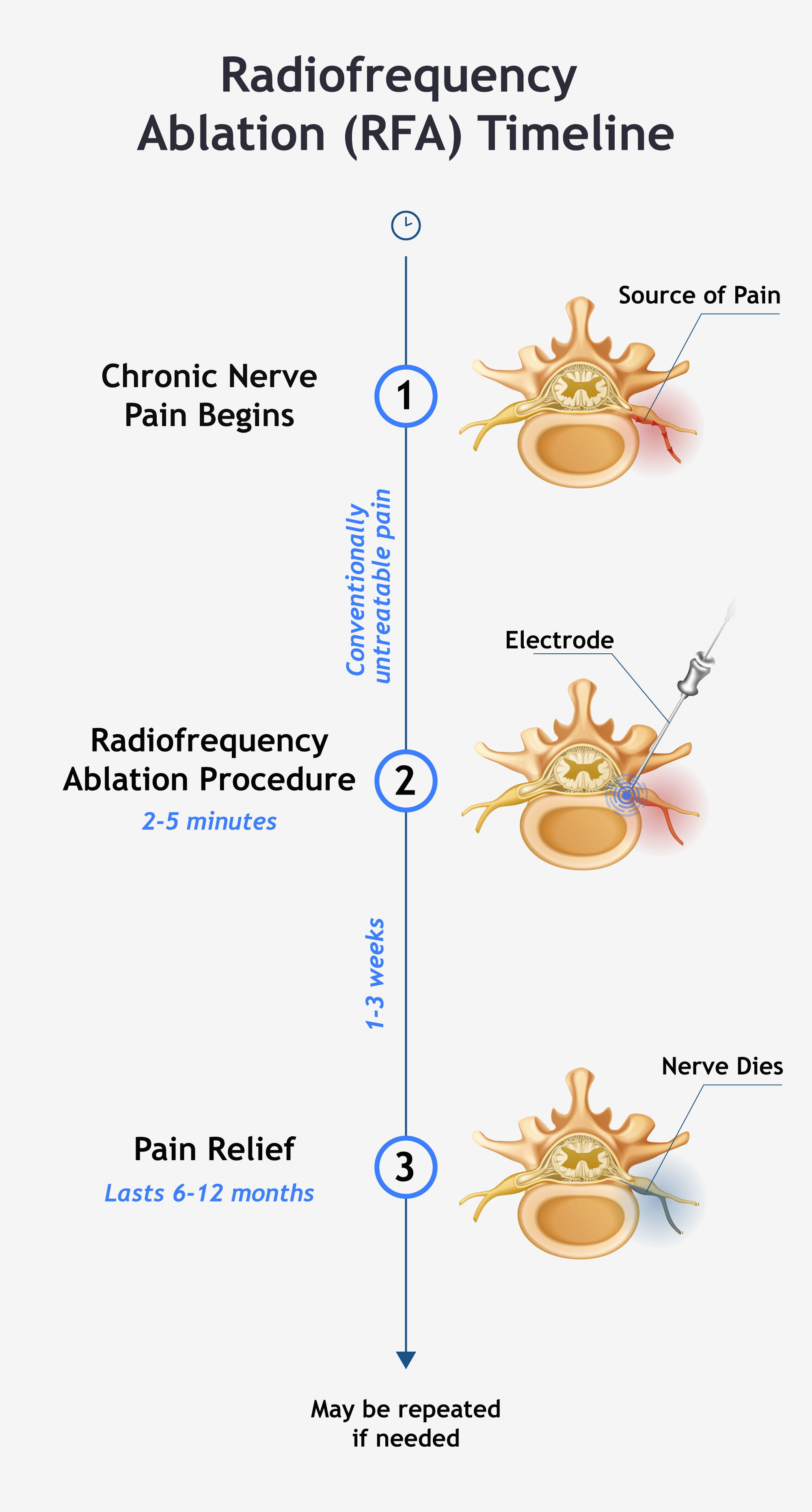 An infographic listing the timeline radiofrequency ablation follows to kill off nerves.